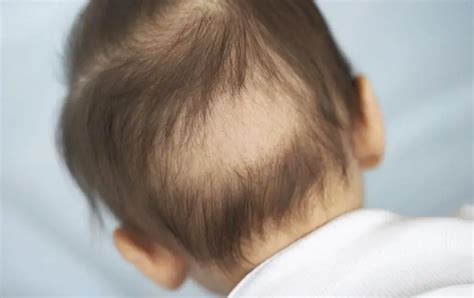 2 yaş bebeklerde saç dökülmesi